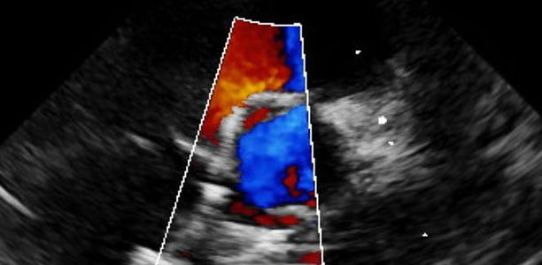 Bild zu Kinderkardiologie - Interventionen bei angeborenen Herzfehlern