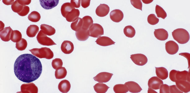 Bild zu Orginalia - Anämie und Eisenmangel bei Kindern und Jugendlichen