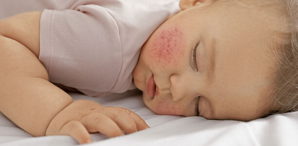 Bild zu Nachgefragt - Allergien, Asthma, Anaphylaxie - 3 Fragen aus der Praxis