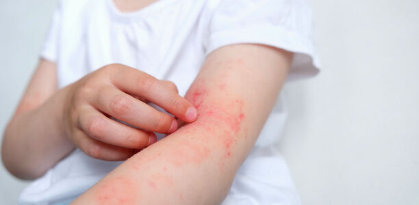 Bild zu Fragen aus der Praxis - Atopische Dermatitis 