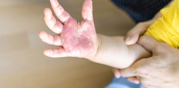 Bild zu Thermische Verletzungen - Verbrühungen und Verbrennungen im Kindesalter