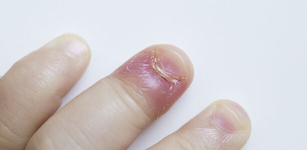 Bild zu Antibiotika-Serie der YoungDGPI - Panaritium – ein alltägliches Krankheitsbild