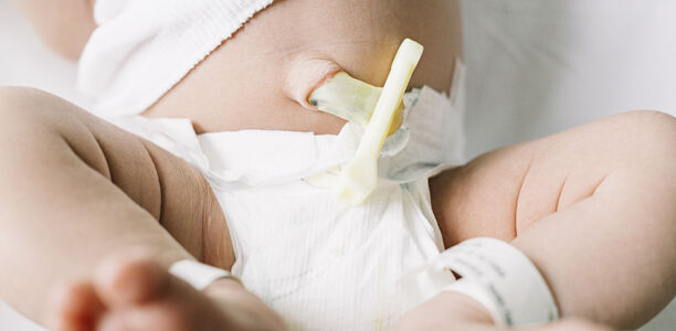 Bild zu Extrem Frühgeborene - Wie wirksam ist das verzögerte Abklemmen der Nabelschnur mit hohem Sauerstoffgehalt?