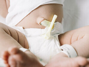 Bild zu Extrem Frühgeborene - Wie wirksam ist das verzögerte Abklemmen der Nabelschnur?