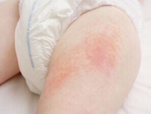 Bild zu KKJ 2025 - Allergie bei Kindern: bessere Früherkennung überfällig