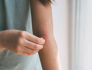 Bild zu Atopische Dermatitis - Welche Faktoren bestimmen Remission oder Persistenz?