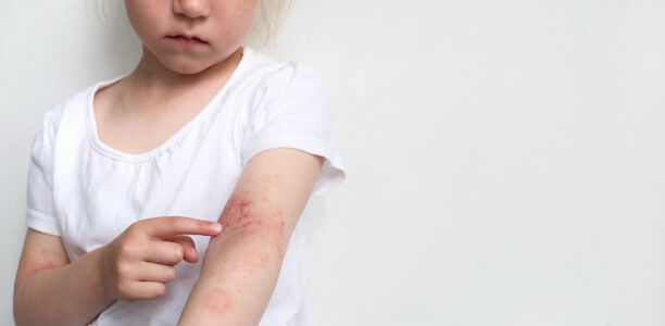 Bild zu Atopische Dermatitis - Nicht nur die Haut, auch die Psyche leidet