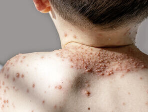 Bild zu Impfprävention-Serie der YoungDGPI - Varizellen und Zoster