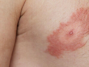 Bild zu Borreliose - Neuigkeiten zum Dauerbrenner