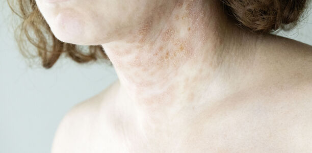 Bild zu Atopische Dermatitis - Betroffene Jugendliche sind seelisch stark belastet